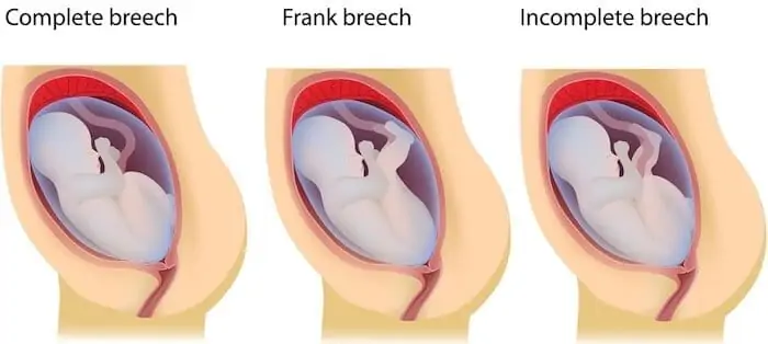 types of breech positions