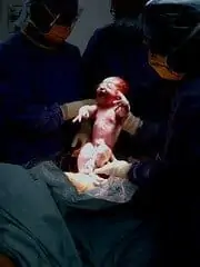 Cesarean birth