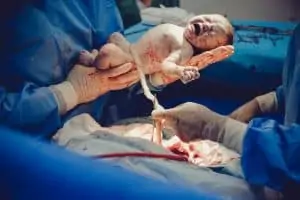 umbilical cord clamping by Doctor