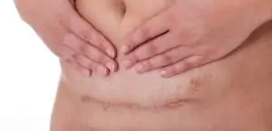 Scar from a c-section birth
