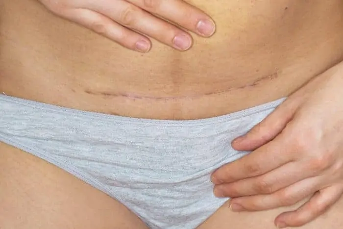 Scar on the belly of a woman who had a caesarean operation