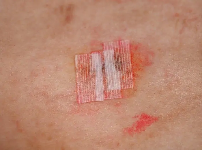 surgical wound with steri strips