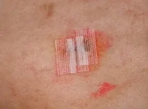 Surgical wound with steri strips