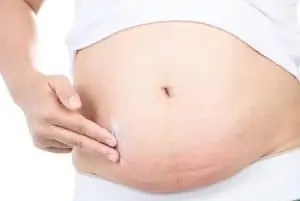 itchiness after cesarean