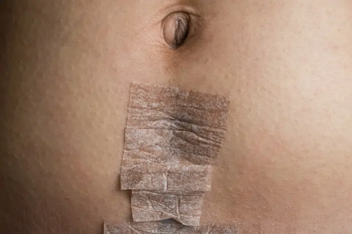 C section stomach covered with medical tape.
