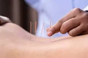 a woman undergoing acupuncture treatment