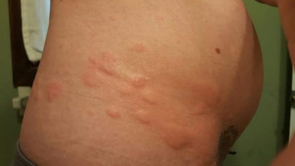 What s Up With That Itchy Rash After C Section Should I Worry 