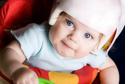 baby wearing helmet for flathead