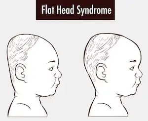 flat head syndrome