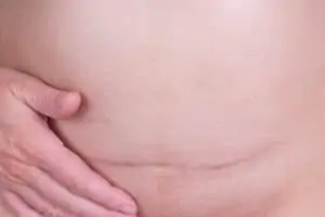 overweight woman cesarean scar