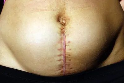 cesarean staples
