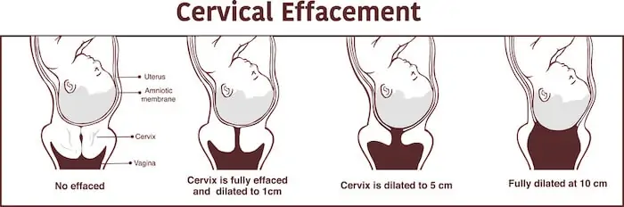 illustration of how cervix stretches and gets thinner