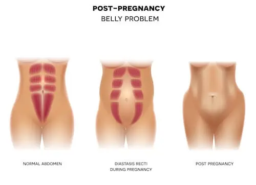 diastasis recti photo for comparison, before and after pregnancy explained