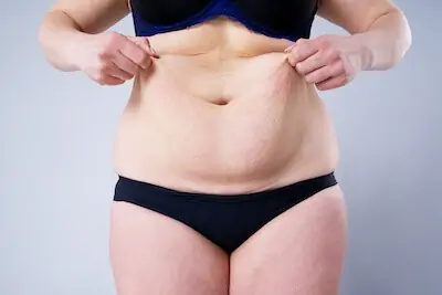 tummy tuck surgery