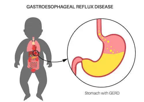 gastroesophageal reflux in baby