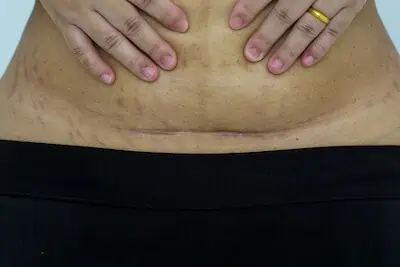 woman shows her scar after c-section