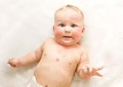 baby having skin rash