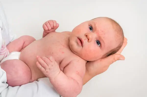 baby skin rash after allergic reaction