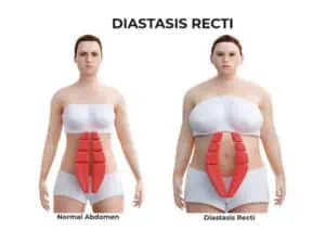diastasis recti stomach seperation