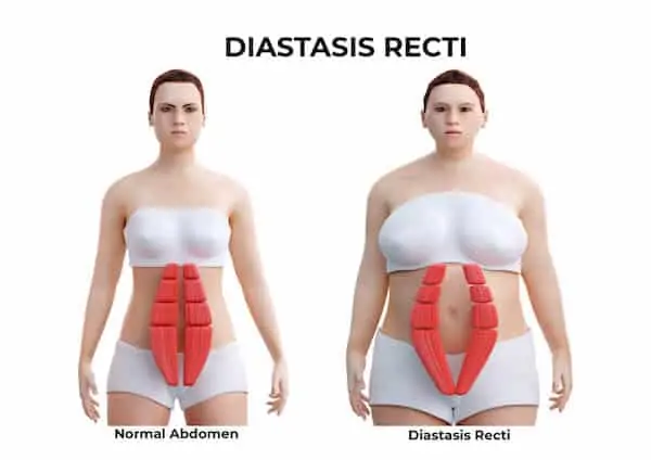 diastasis recti stomach seperation