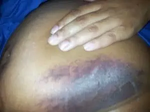 bruise around stomach after cesarean section